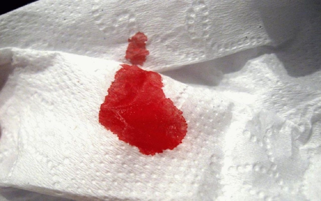hiện tượng máu tươi kèm theo sa búi trĩ là dấu hiệu cảnh báo bệnh trĩ